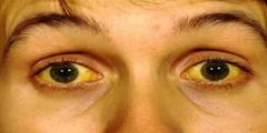 علاج اصفرار العين