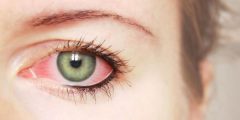 كيفية التخلص من احمرار العين