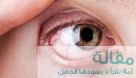 ما هي أعراض جفاف العين