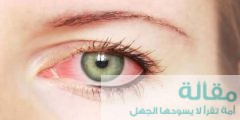 ما هي أسباب احمرار بياض العين