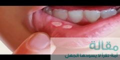 علاج فطريات الفم