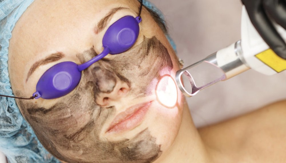 علاج الوجه بالليزر الكربوني