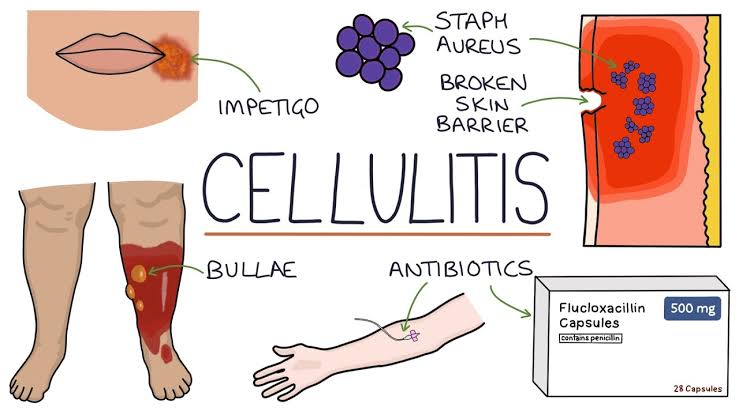التهاب النسيج الخلوي Cellulitis و اعراضه و اسبابه