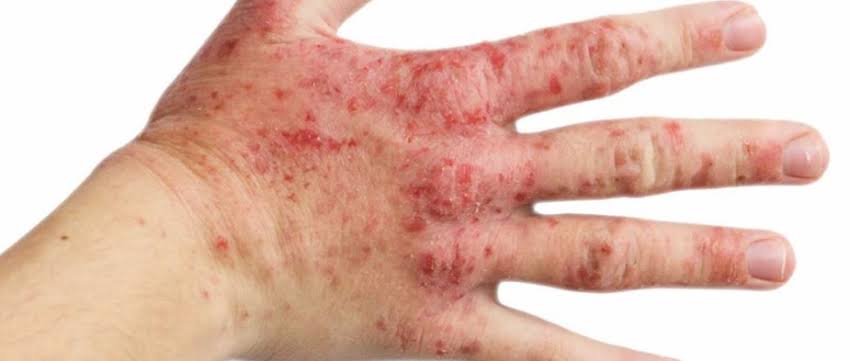 ما هي الاكزيما Eczema و أسبابها و اعراضها و علاجها