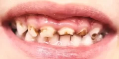 أسباب تسوس الأسنان رغم تنظيفها