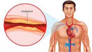 أعراض ارتفاع الكوليسترول والدهون الثلاثية  