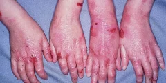 علاج مرض الجلد الفقاعي