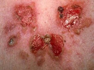 علاج مرض الجلد الفقاعي